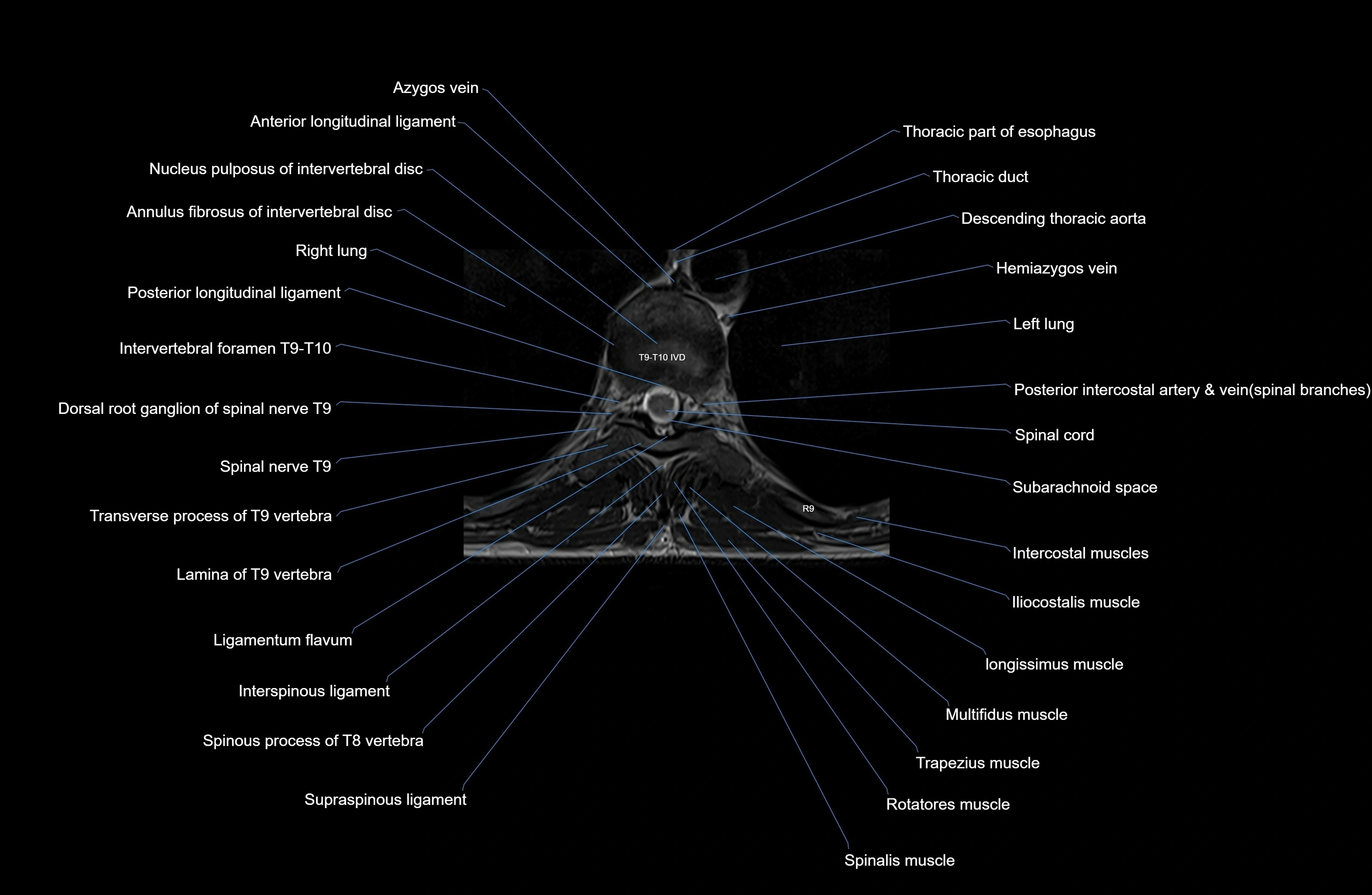 MRI thoracic spine axial  cross sectional anatomy 3T radiology  image-img-00001-00061.webp